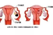 子宫腺肌瘤的治疗方法